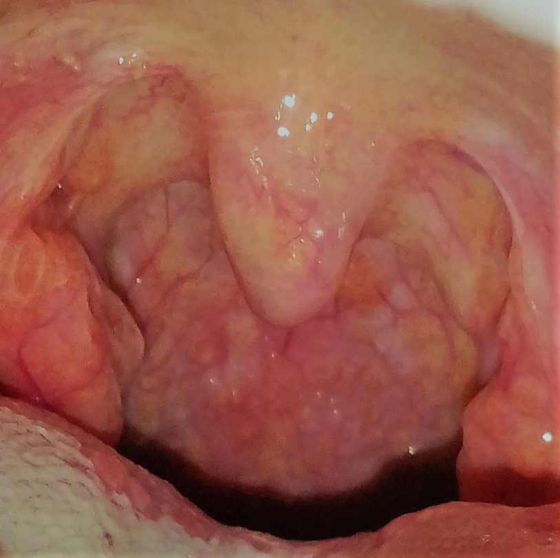 Surgery for Tonsillectomy