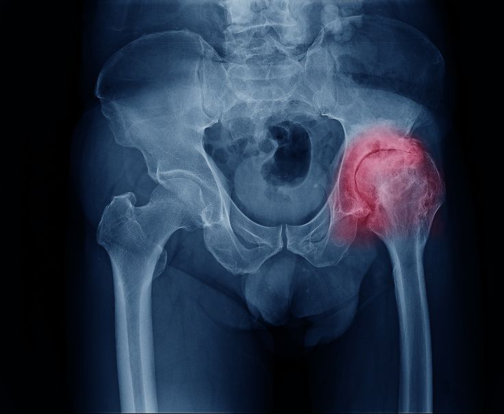 Please Help Me Treat AVN and Save My Left Hip