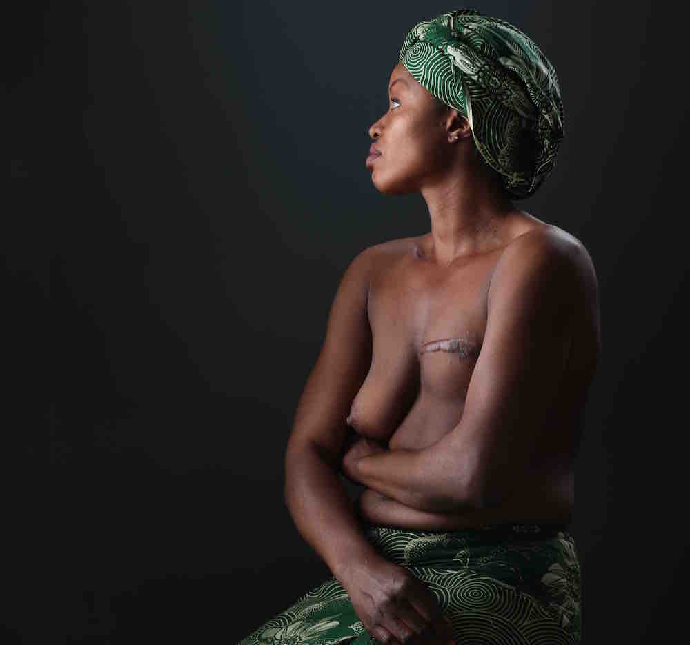 Save Oyayi from Stage II Breast Cancer
