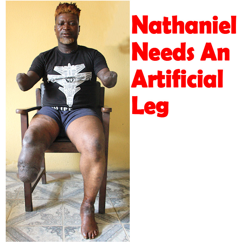 Nathaniel Needs An Ultra-Modern Artificial Leg