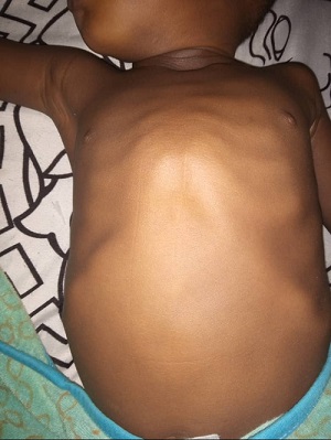 Help Asher Osagie Fund His Open Heart Surgery.