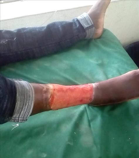 FREE TREATMENT FOR SICKLE CELL LEG ULCER