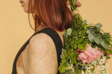 financial aid for burn victims