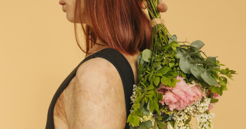 financial aid for burn victims